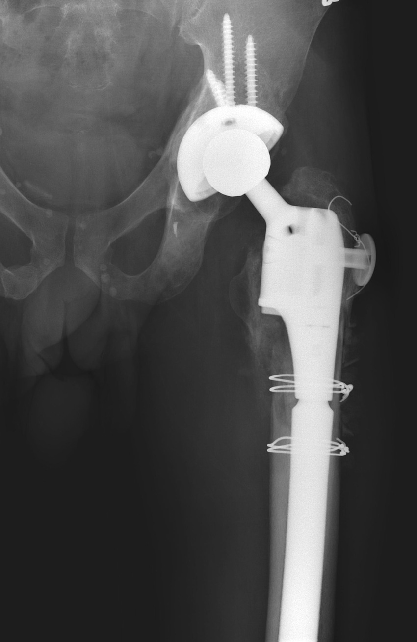 Type 3 Revision Femur 2